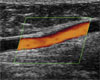 Дуплексное сканирование бедренная артерия